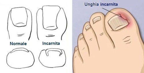 L'unghia incarnita o onicocriptosi è quella condizione in cui un angolo appuntito dell'unghia del piede penetra nella pelle provocando dolore,arrossamento ed infiammazione.