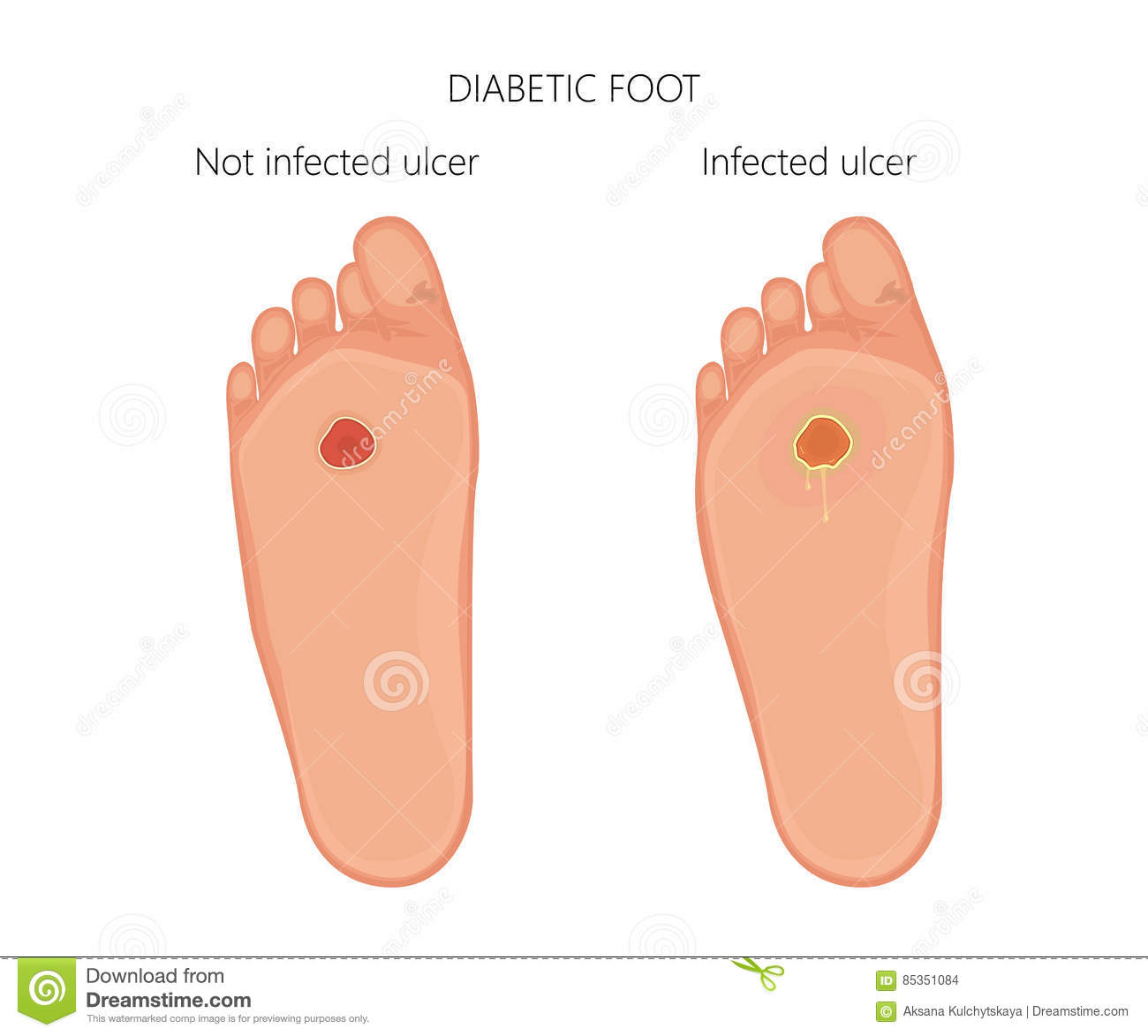 piede diabetico con l ulcera infettata