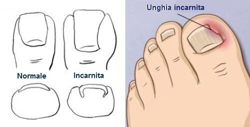 L'unghia incarnita o onicocriptosi è quella condizione in cui un angolo appuntito dell'unghia del piede penetra nella pelle provocando dolore,arrossamento ed infiammazione.